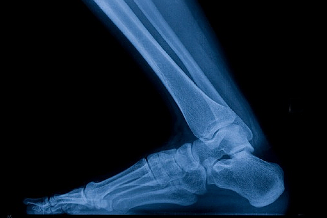 3 solutions for ankle mobility
